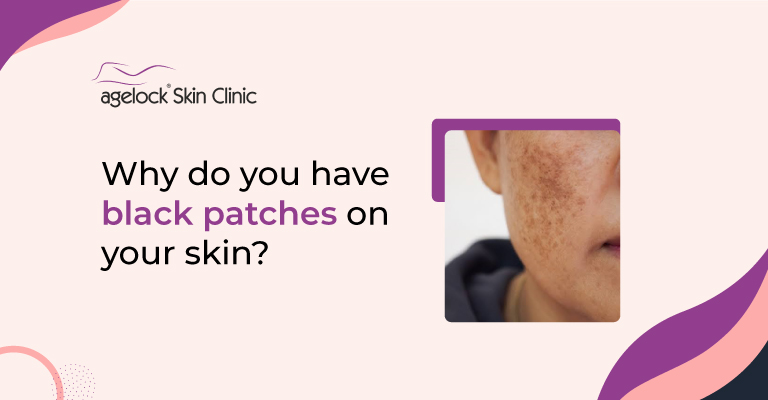 Why do you have black patches on your skin?