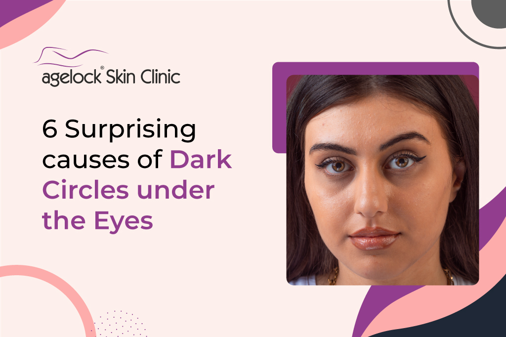 <strong>6 surprising causes of dark circles under the eyes</strong>