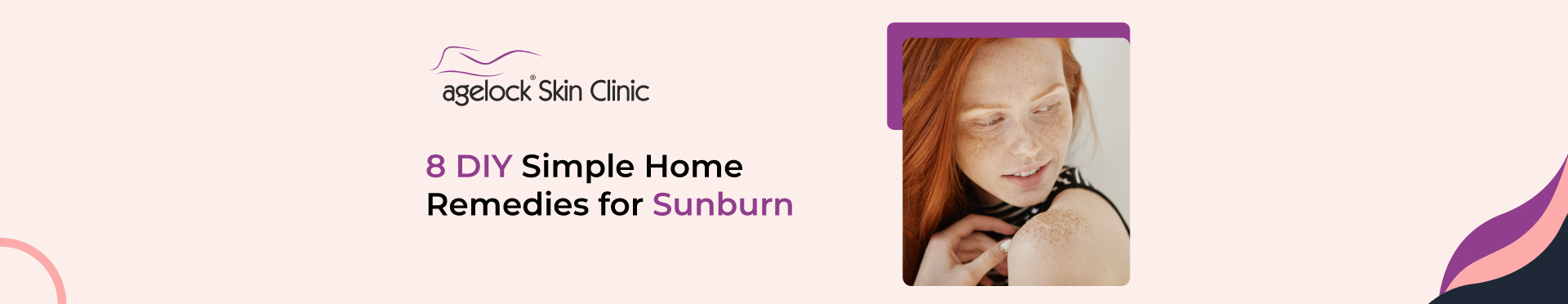 8 DIY Simple Home Remedies for Sunburn