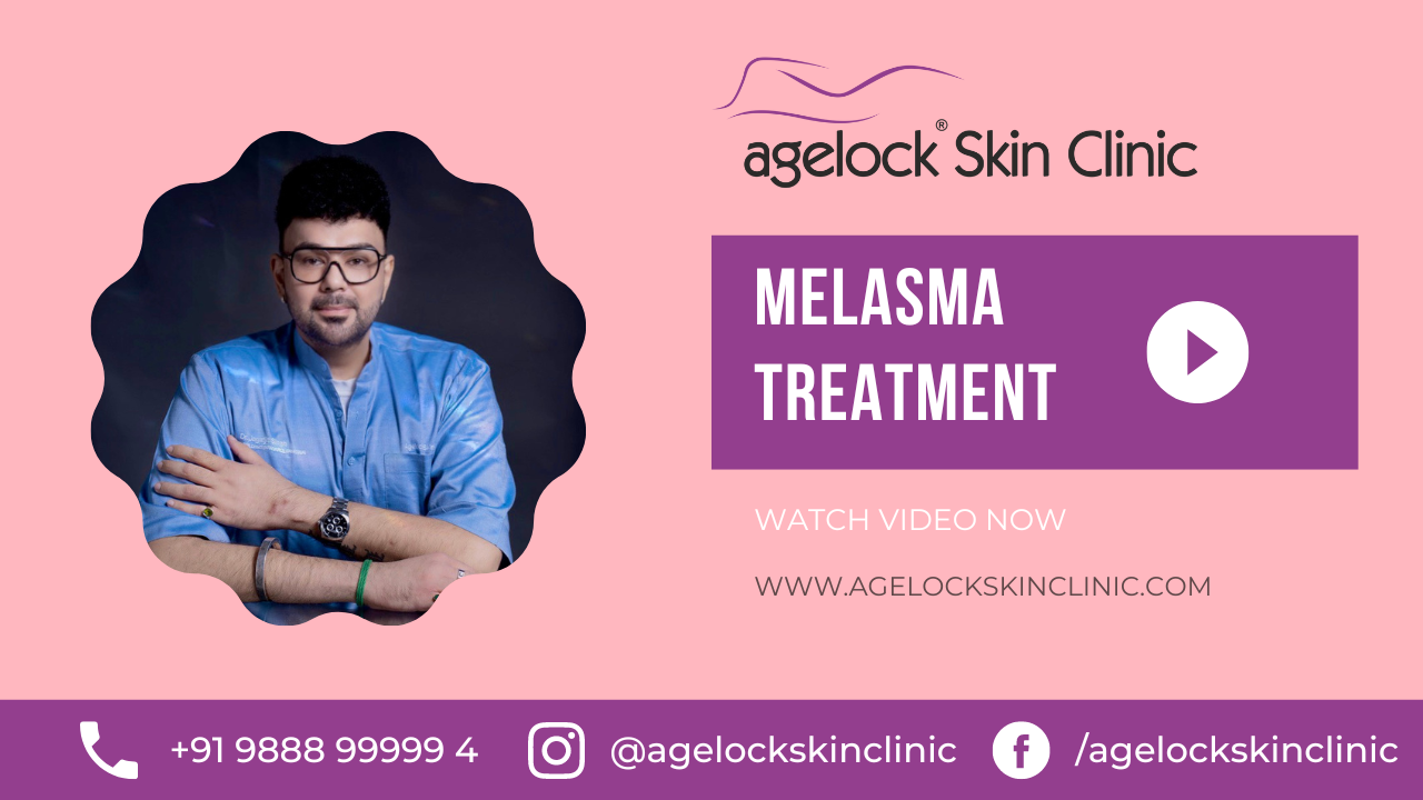 Melasma Treatement