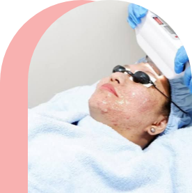Laser Treatment for Pimple Removal