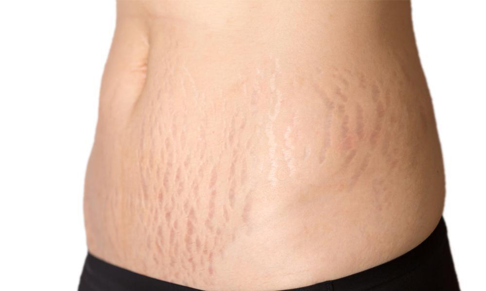 Vivace Stretch Marks Removal Treatment