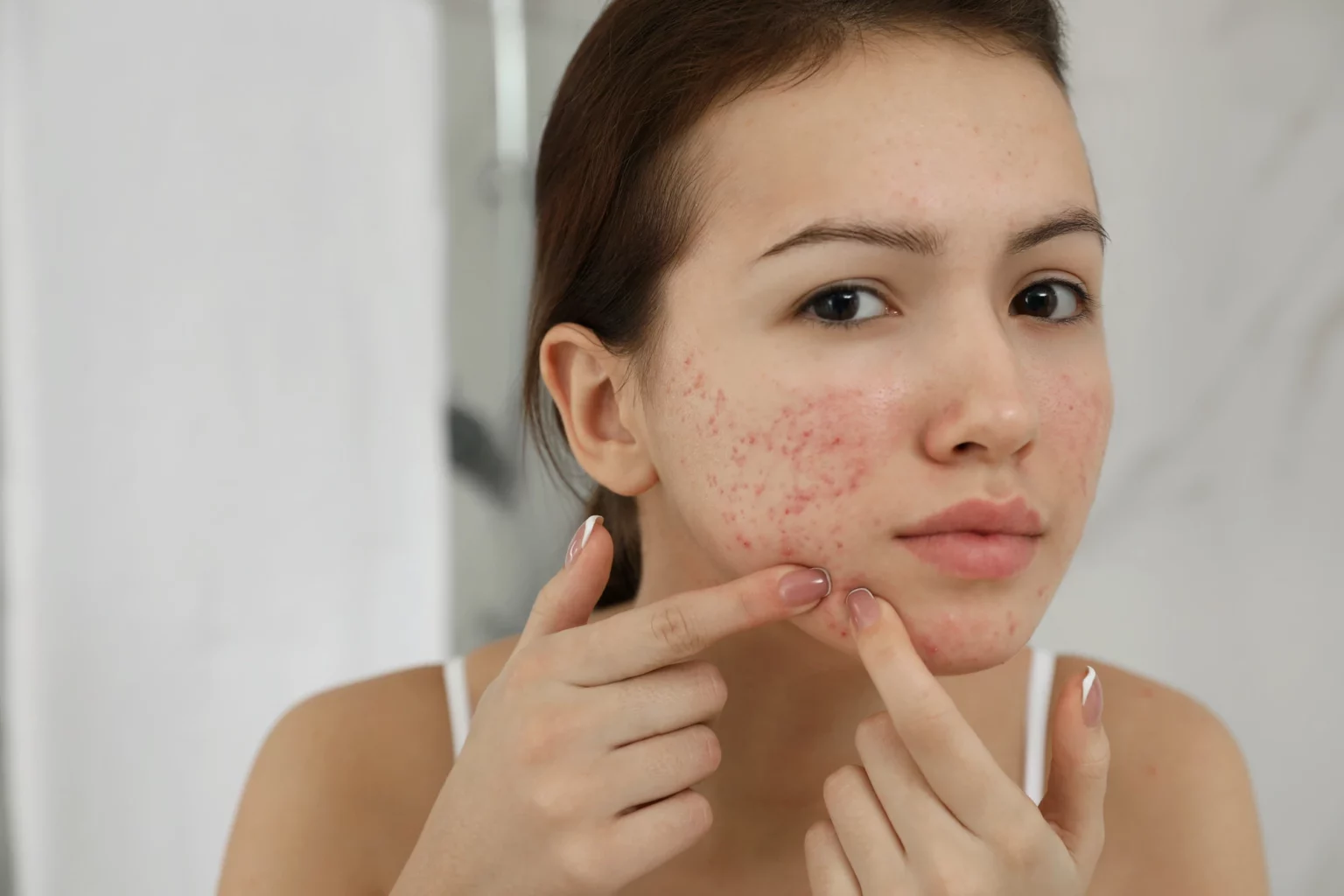Acne Check Peel in Chandigarh