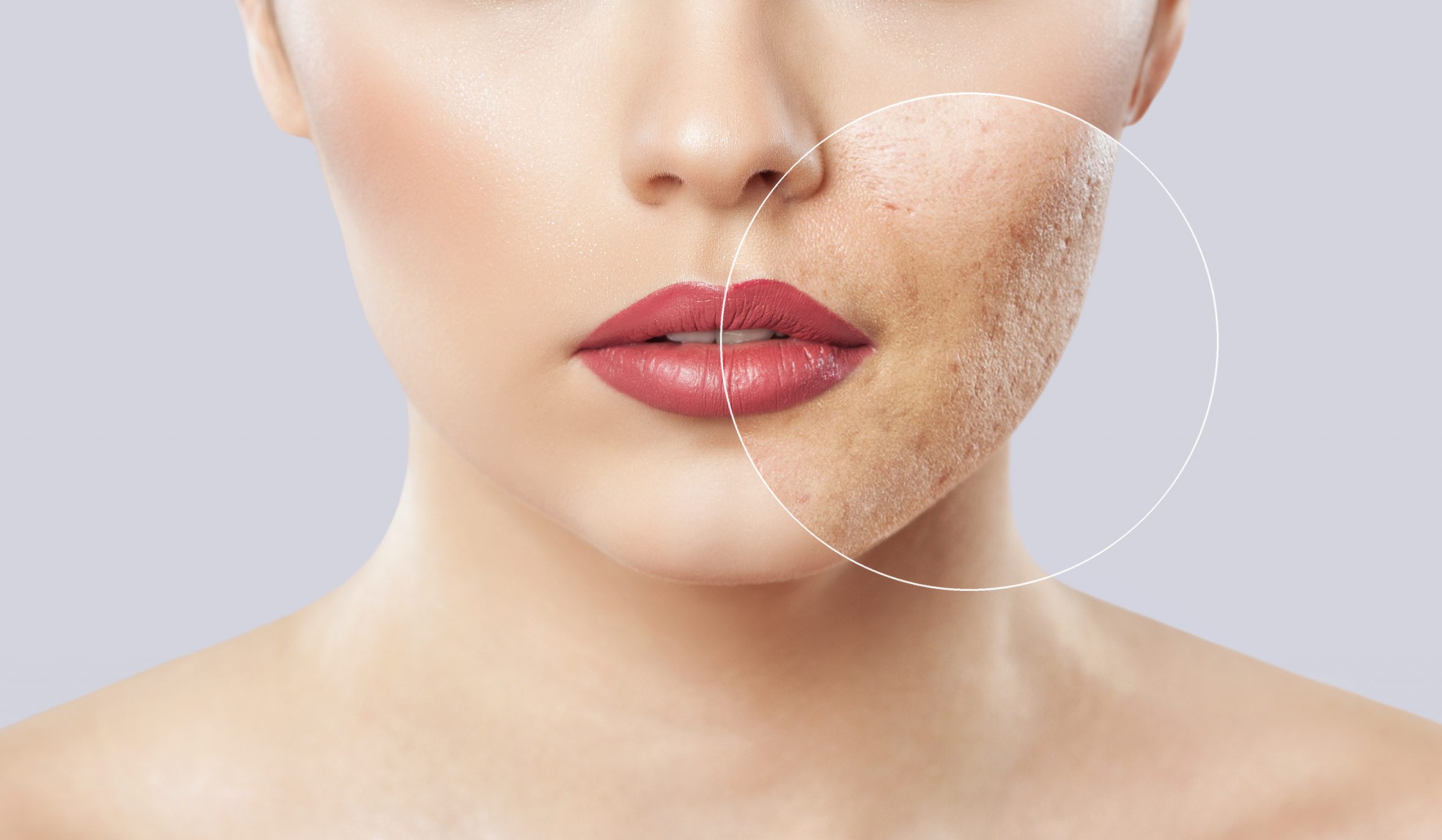 Acne Check Peel in Chandigarh