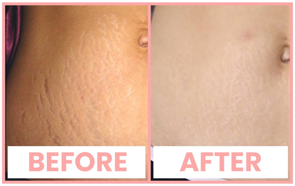 Prp Treatment For Stretch Mark Removal In Chandigarh