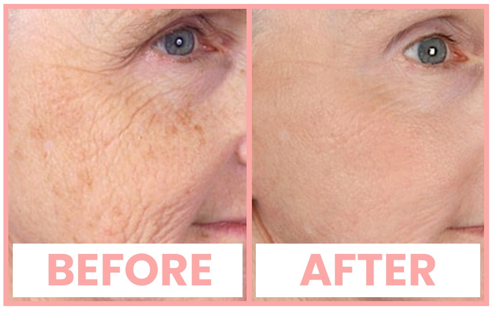 Vivace Anti Aging Treatment in Chandigarh