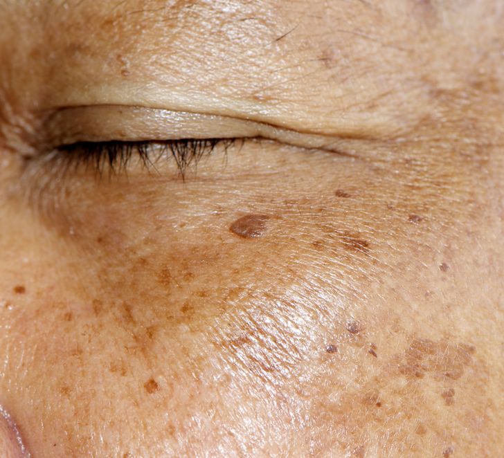 Mesotherapy for Hyperpigmentation
