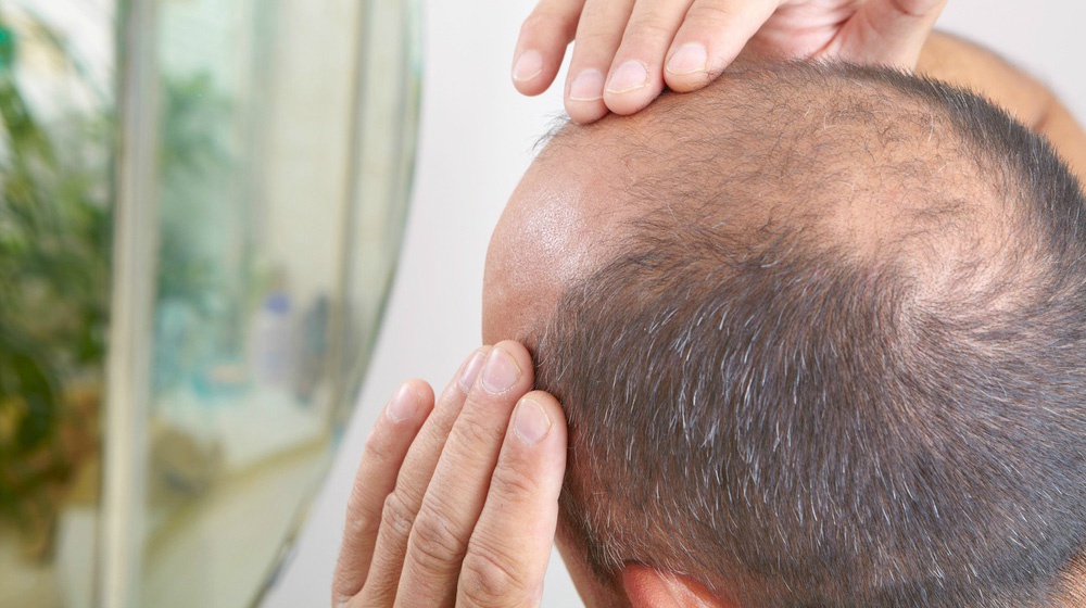 Stem Cell Injections for Hairloss in Chandigarh