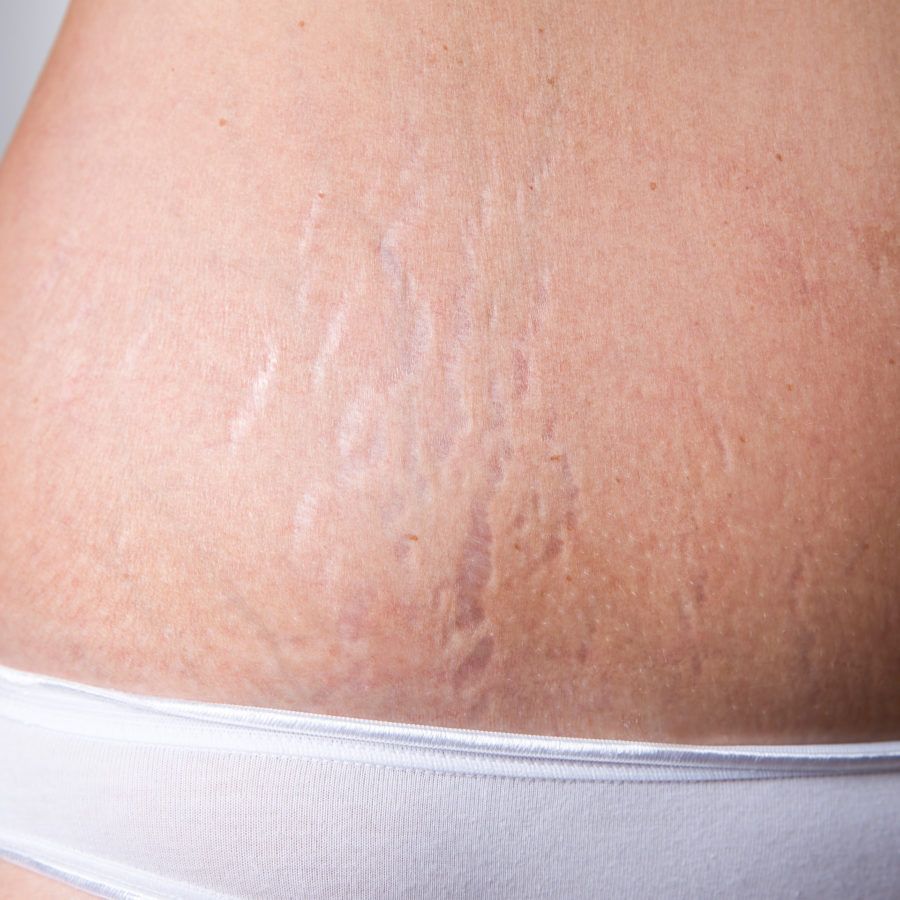 Prp Treatment For Stretch Mark Removal In Chandigarh