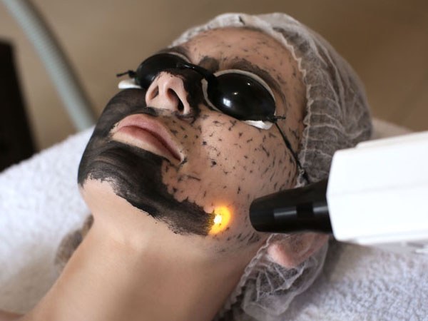 Carbon Laser Peel For Acne Treatment in Chandigarh