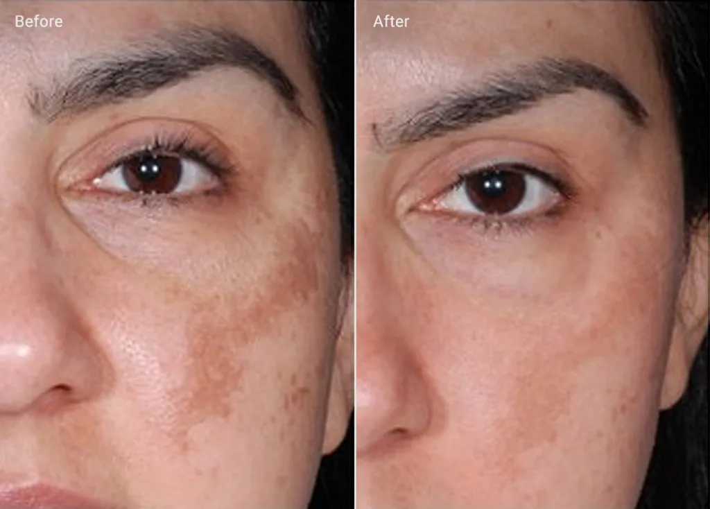 Skin Pigmentation