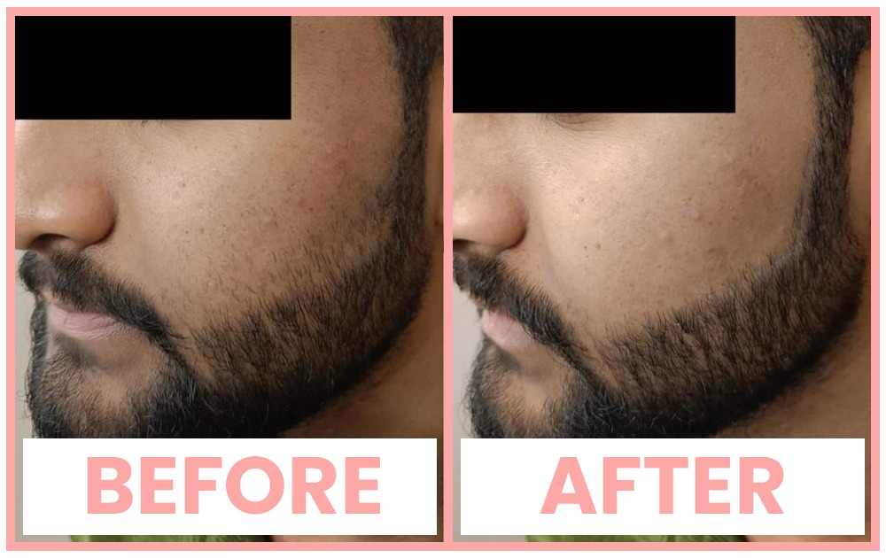 Beard Shaping in Chandigarh