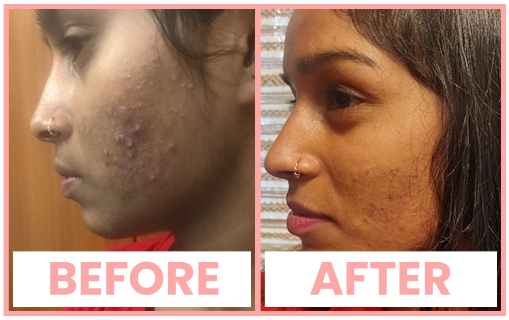 Chemical Peels