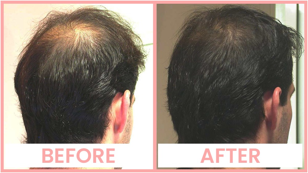 Hair Mesotherapy Treatment in Chandigarh