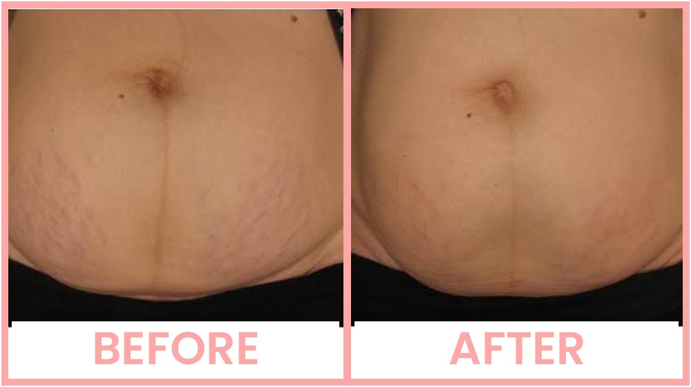 Vivace Stretch Marks Removal Treatment