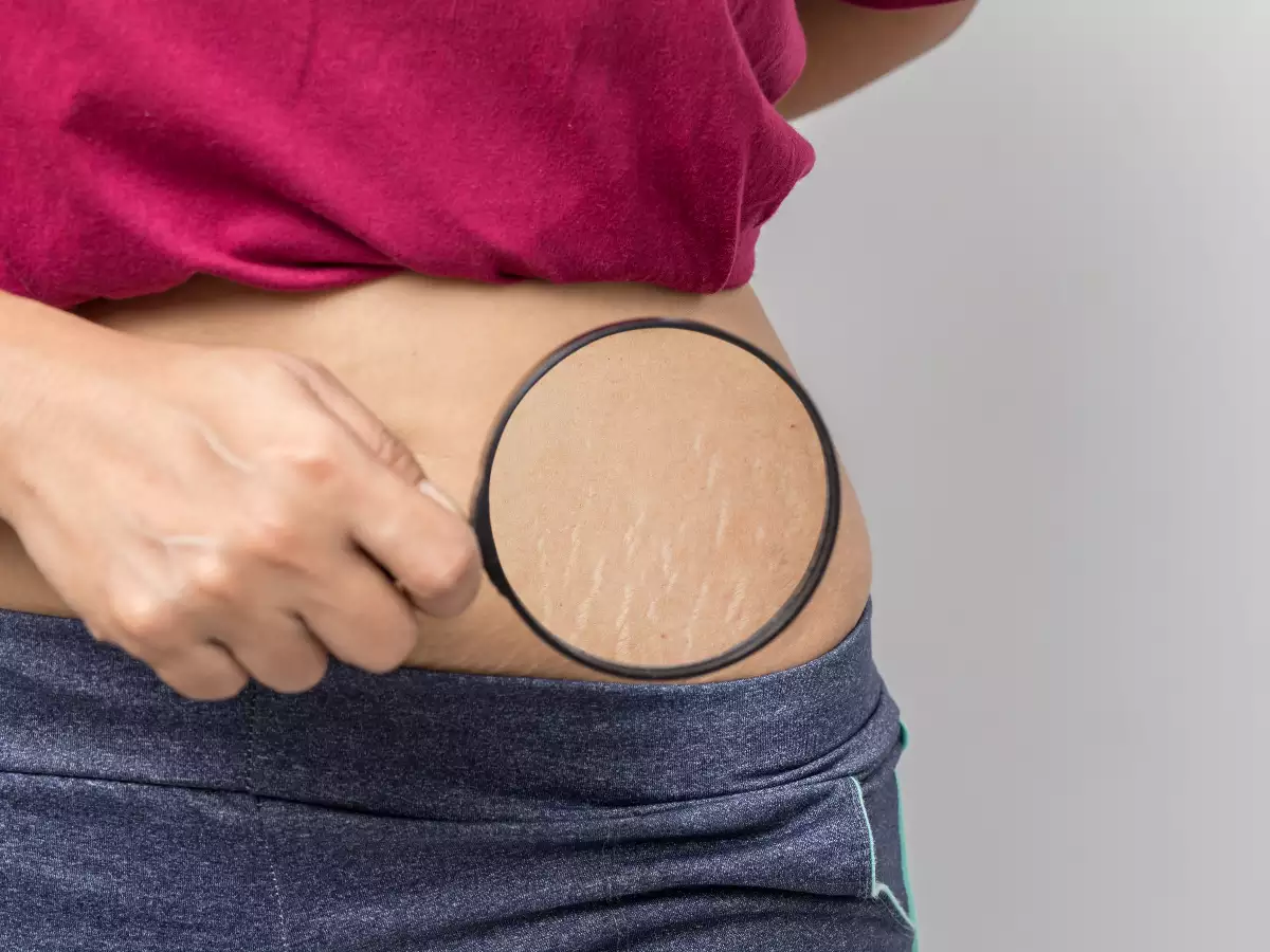 Stretch Marks