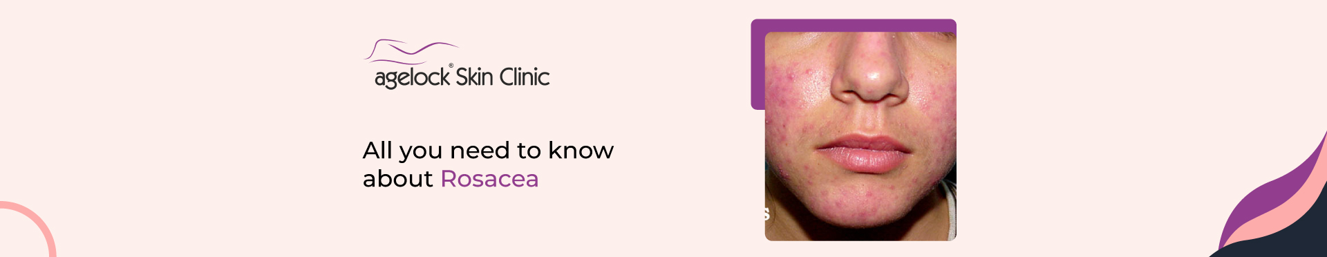 <strong>All you need to know about Rosacea: Symptoms, causes, and treatment</strong>