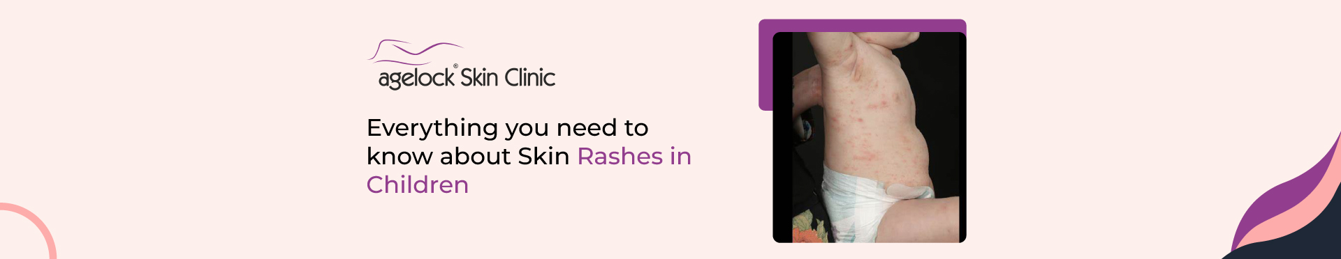 <strong>Everything you need to know about skin rashes in children – Causes, prevention, and treatment</strong>