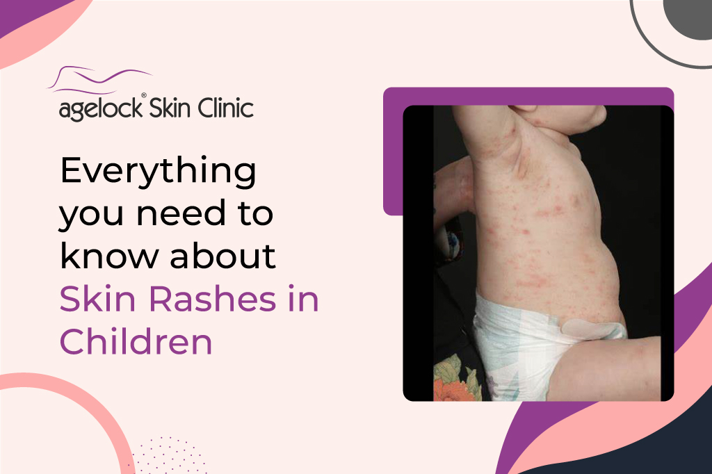 <strong>Everything you need to know about skin rashes in children – Causes, prevention, and treatment</strong>