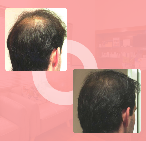 Hairfall Treatment in Chandigarh