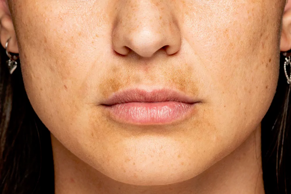 Photo Facial in Chandigarh