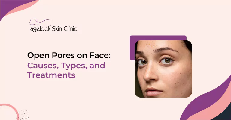 Open Pores on Face: Causes, Types, and Treatments